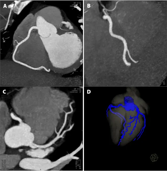 Computed tomography of the heart &#8211; an alternative to coronography. When to perform and how is a cardiac CT performed?