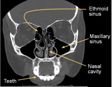 Computed tomography of the sinuses &#8211; indications and contraindications. The course of sinus tomography