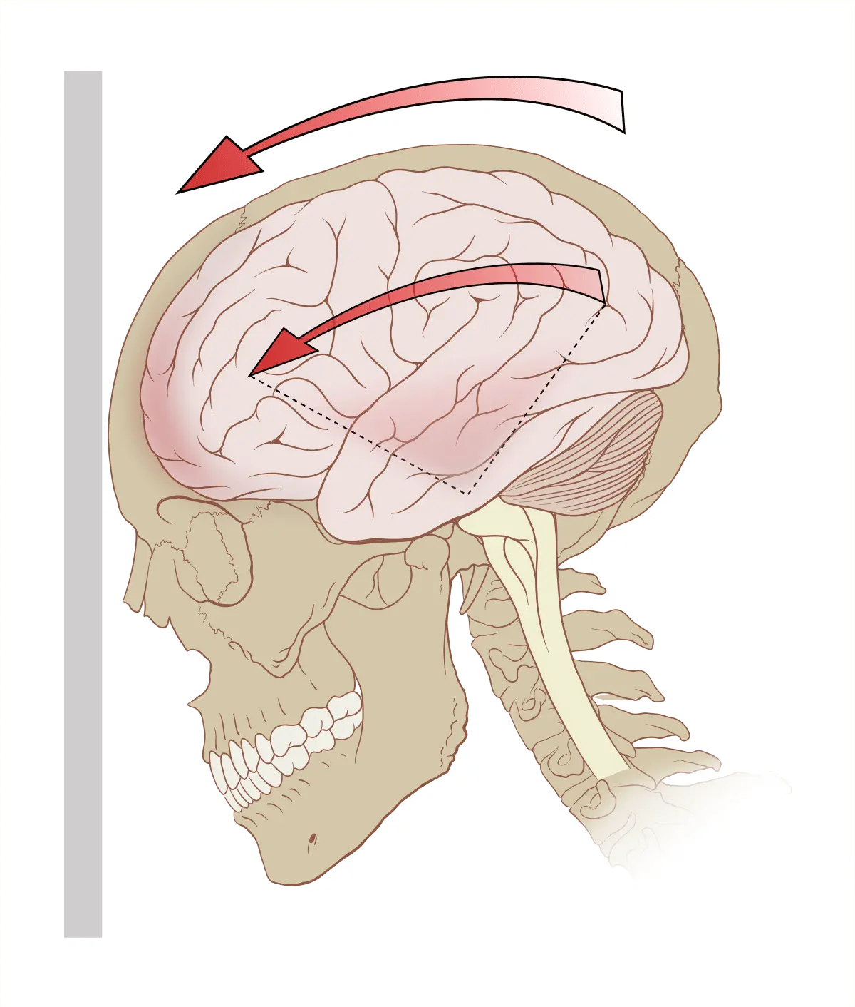 Concussion of the brain (concussion)