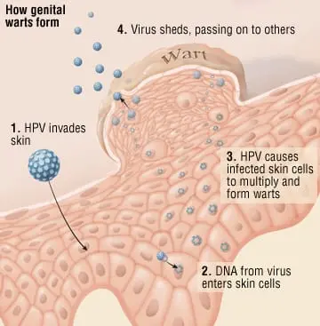 Condylomas in women and men. What is the treatment of genital warts?