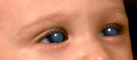 Congenital (childhood) glaucoma &#8211; definition, causes, symptoms, treatment