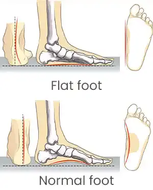 Congenital flat foot