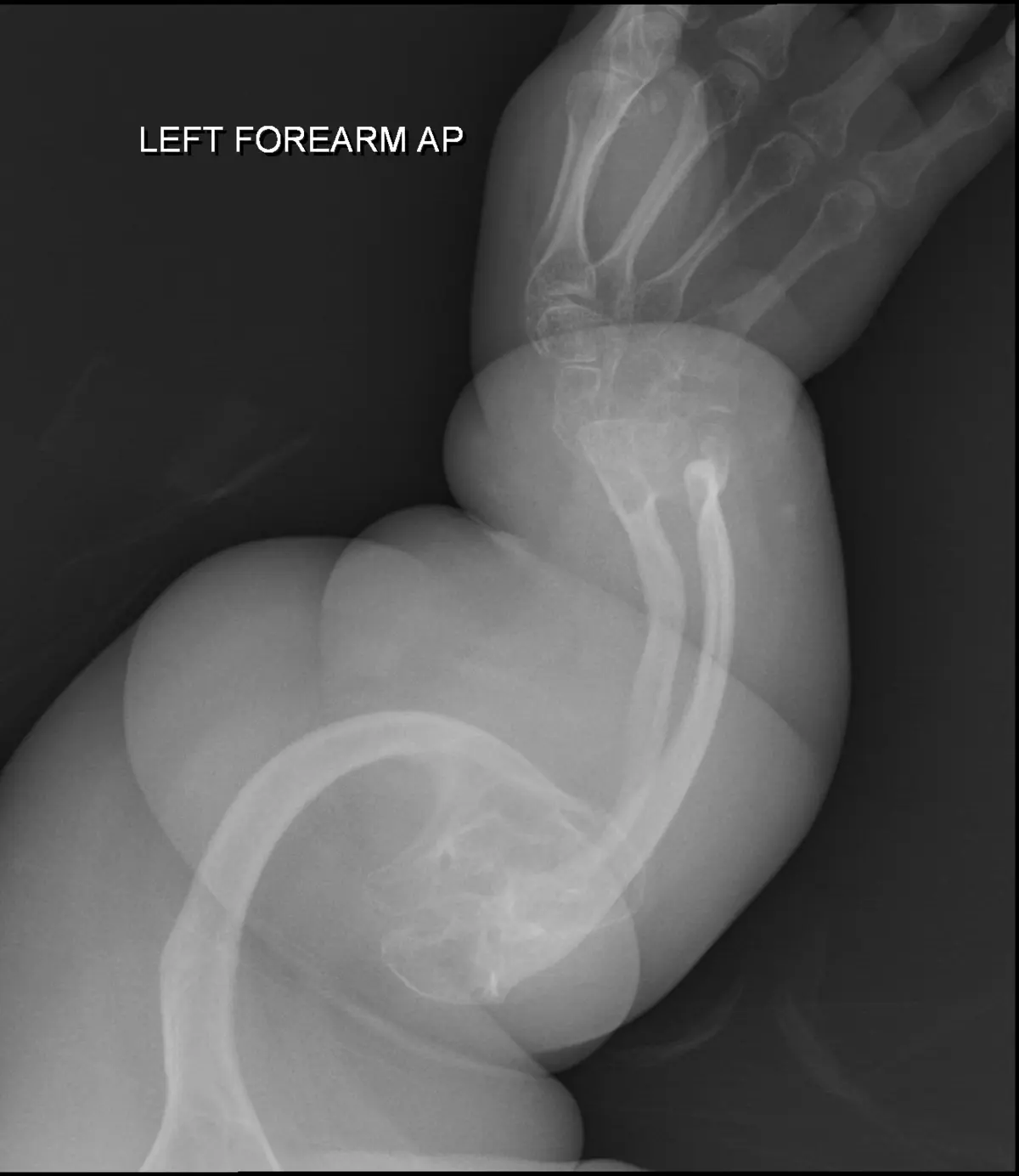 Congenital fragility of bones &#8211; symptoms and treatment