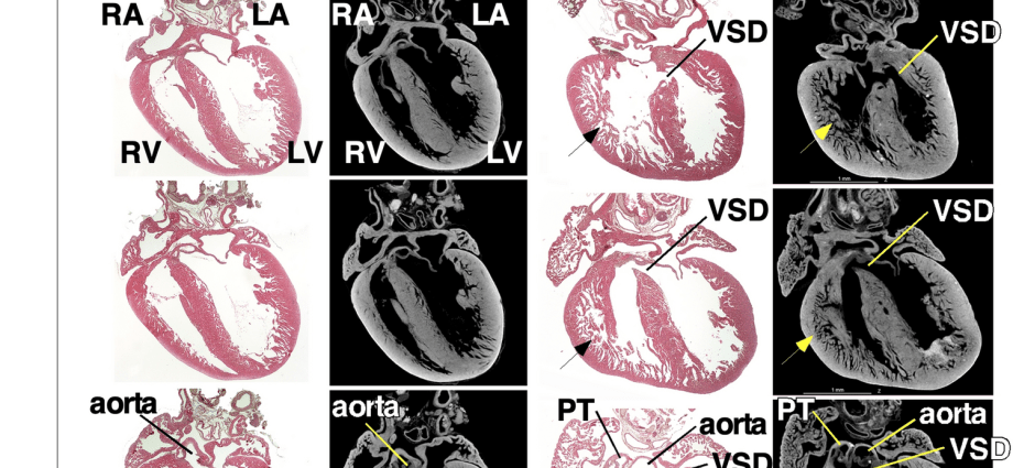 Congenital heart defect &#8211; can it reverse on its own? The doctor answers