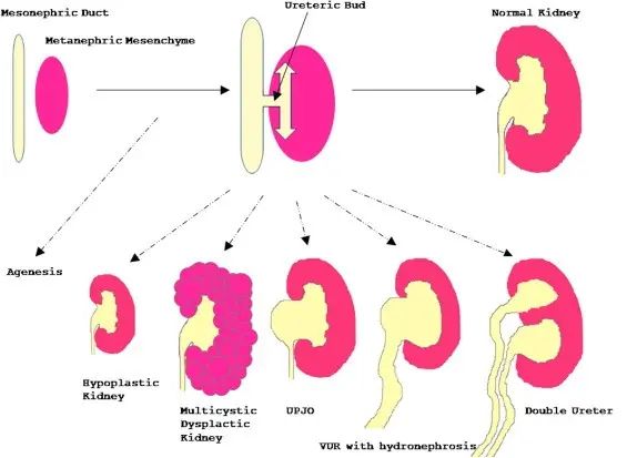 Congenital kidney defects associated with mental disorders