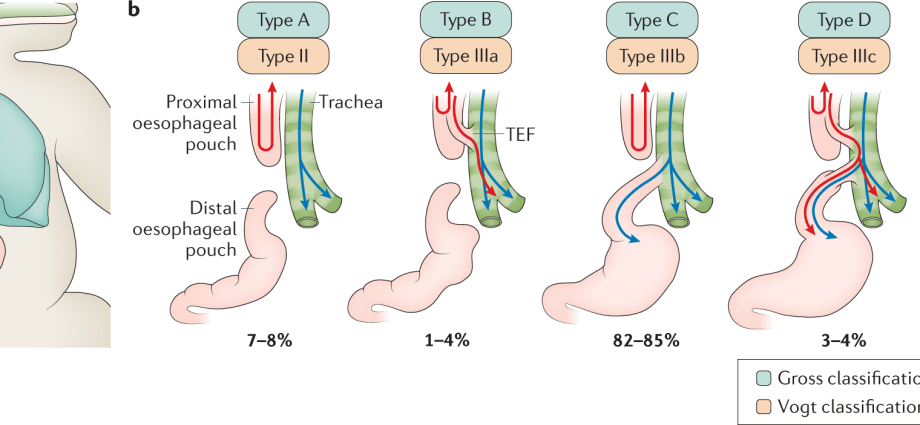 Congenital obstruction (atresia) of the esophagus &#8211; causes, symptoms, diagnosis, treatment