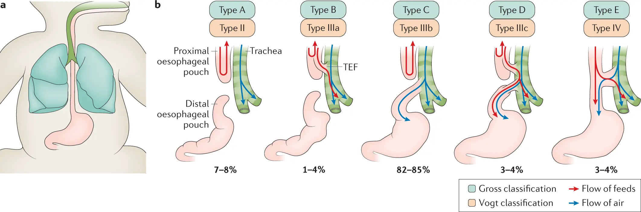 Congenital obstruction (atresia) of the esophagus &#8211; causes, symptoms, diagnosis, treatment