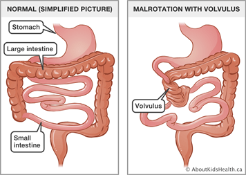 Congenital obstruction of the gastrointestinal tract