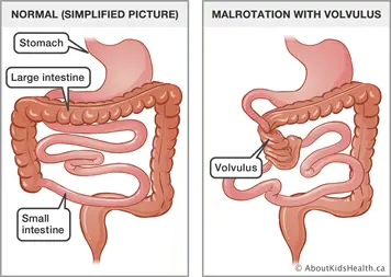 Congenital obstruction of the gastrointestinal tract