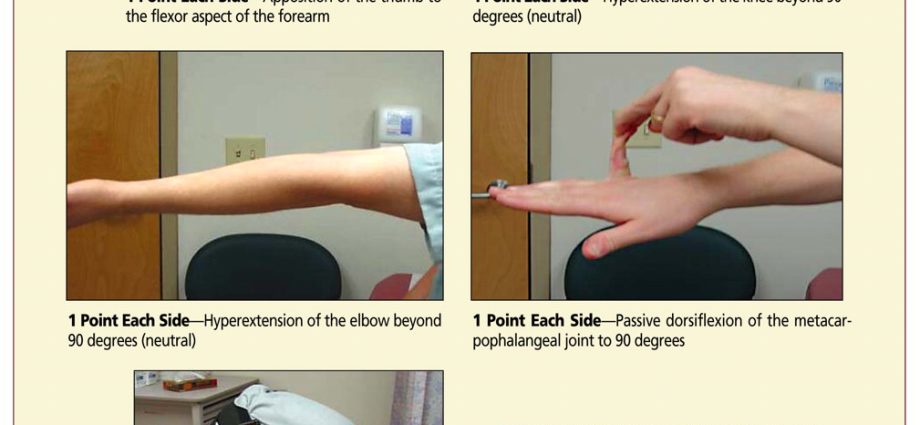 Congenital skin laxity &#8211; symptoms, diagnosis, possible treatment