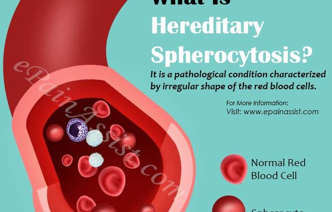 Congenital spherocytosis &#8211; causes, symptoms, treatment