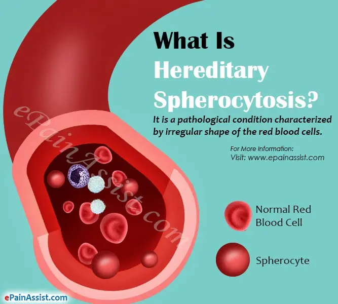 Congenital spherocytosis &#8211; causes, symptoms, treatment