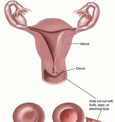 Conization &#8211; what is the procedure? How much does cervical conization cost?