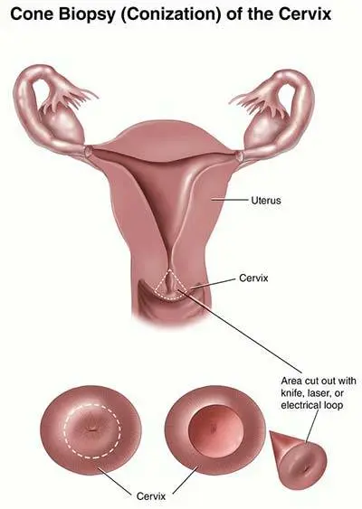 Conization &#8211; what is the procedure? How much does cervical conization cost?