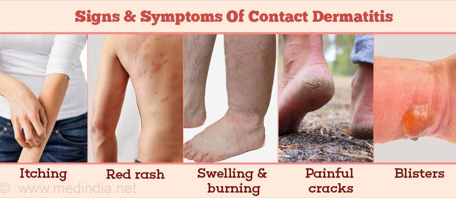 Contact dermatitis &#8211; symptoms, types, diagnosis