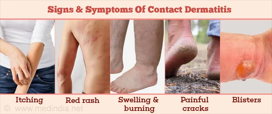 Contact dermatitis &#8211; symptoms, types, diagnosis