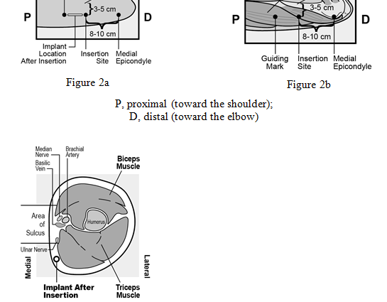 Contraceptive implant &#8211; structure, purpose, operation [EXPLAINED]