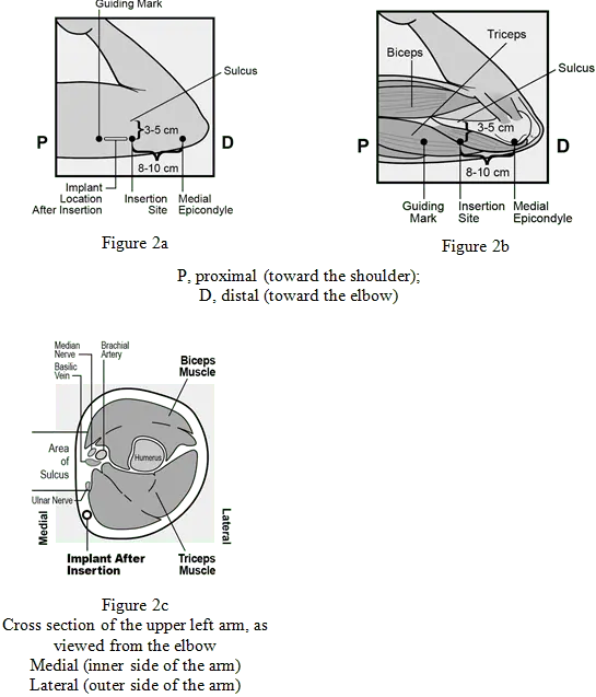 Contraceptive implant &#8211; structure, purpose, operation [EXPLAINED]