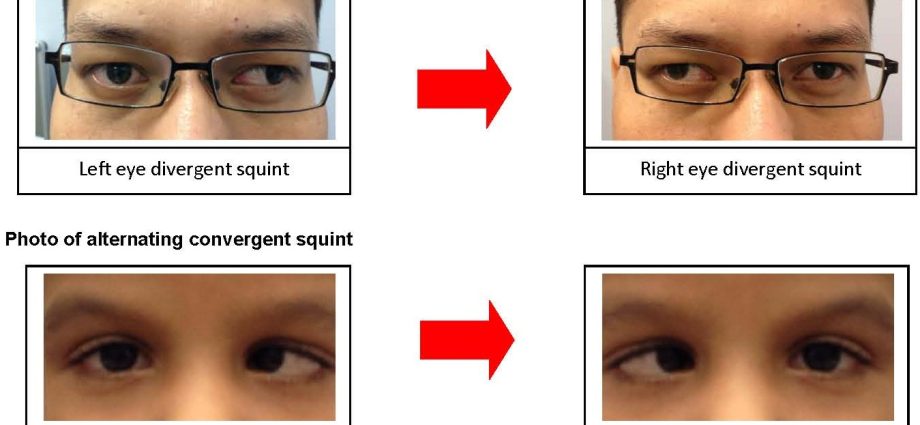 Convergent and divergent strabismus in an infant &#8211; symptoms, treatment