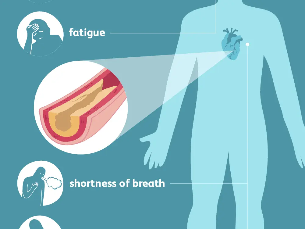 Coronary artery disease is one of the most common causes of death. What are the symptoms?