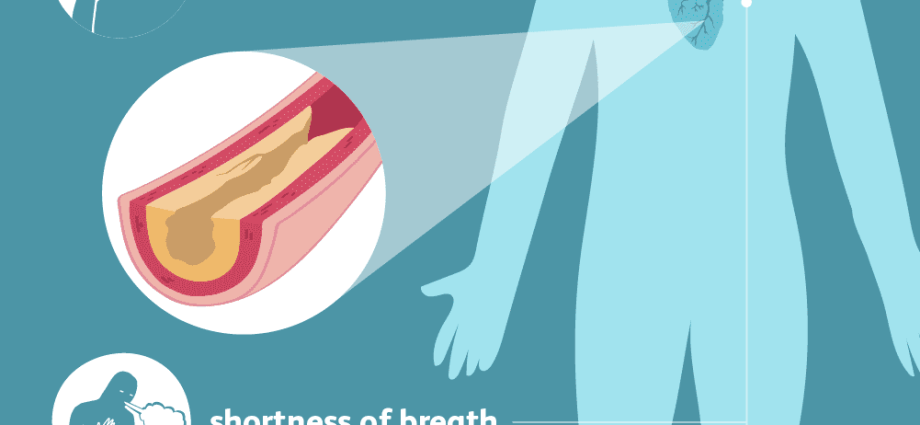 Coronary artery disease. Symptoms and treatment of ischemic heart disease