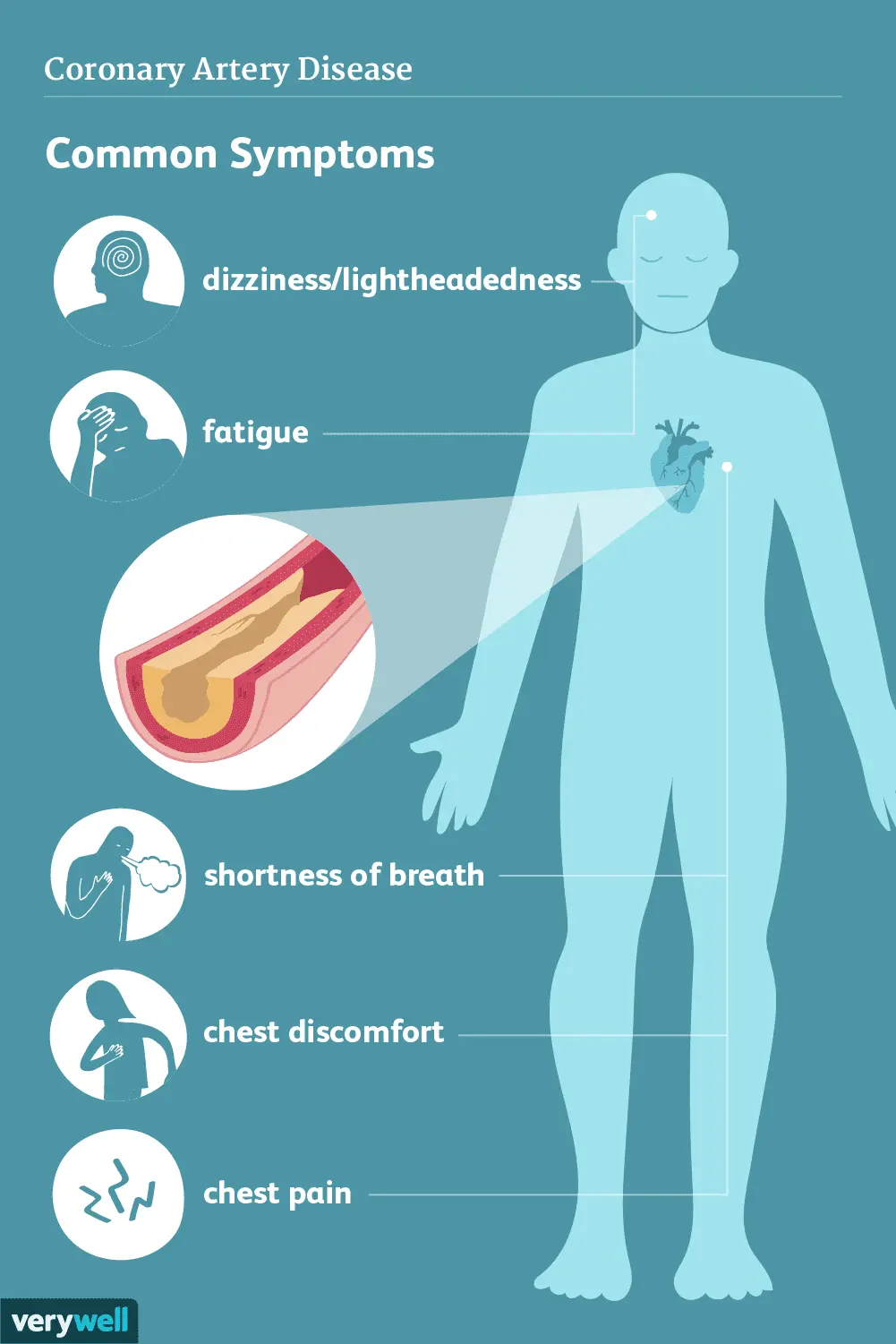 Coronary artery disease. Symptoms and treatment of ischemic heart disease