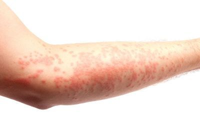 Coronavirus symptoms on the skin. Infected people may develop a rash