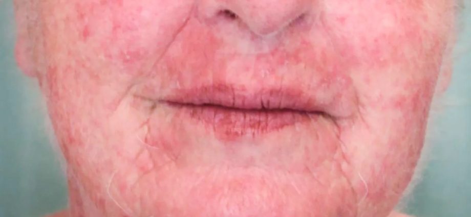 Could the rash on the face be caused by an allergic reaction?