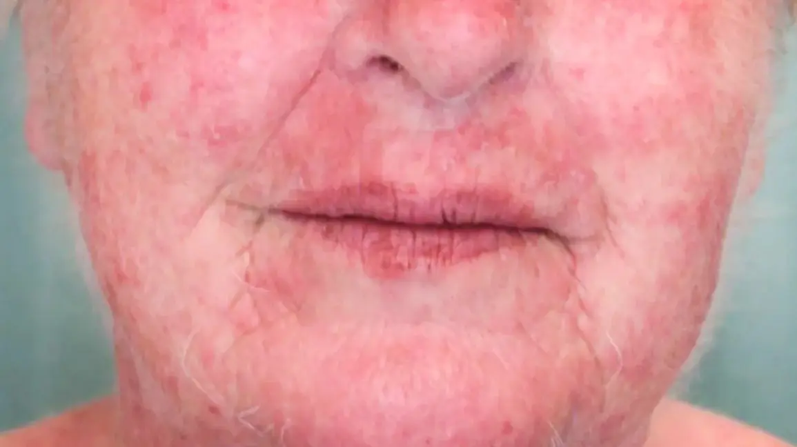 Could the rash on the face be caused by an allergic reaction?