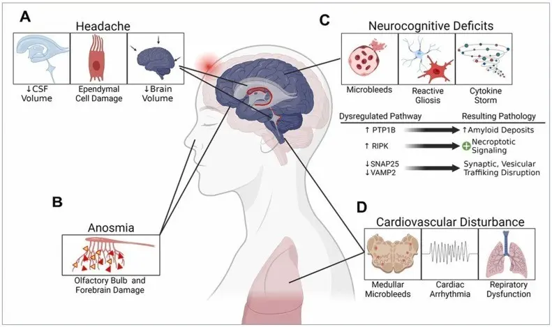 COVID-19 Accelerates Brain Aging? Disturbing information