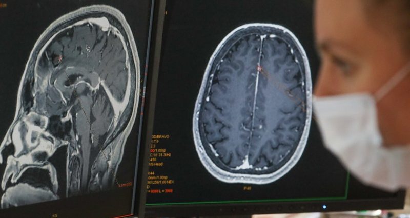 COVID-19 patients can suffer from &#8220;brain fog&#8221;. It lasts for months