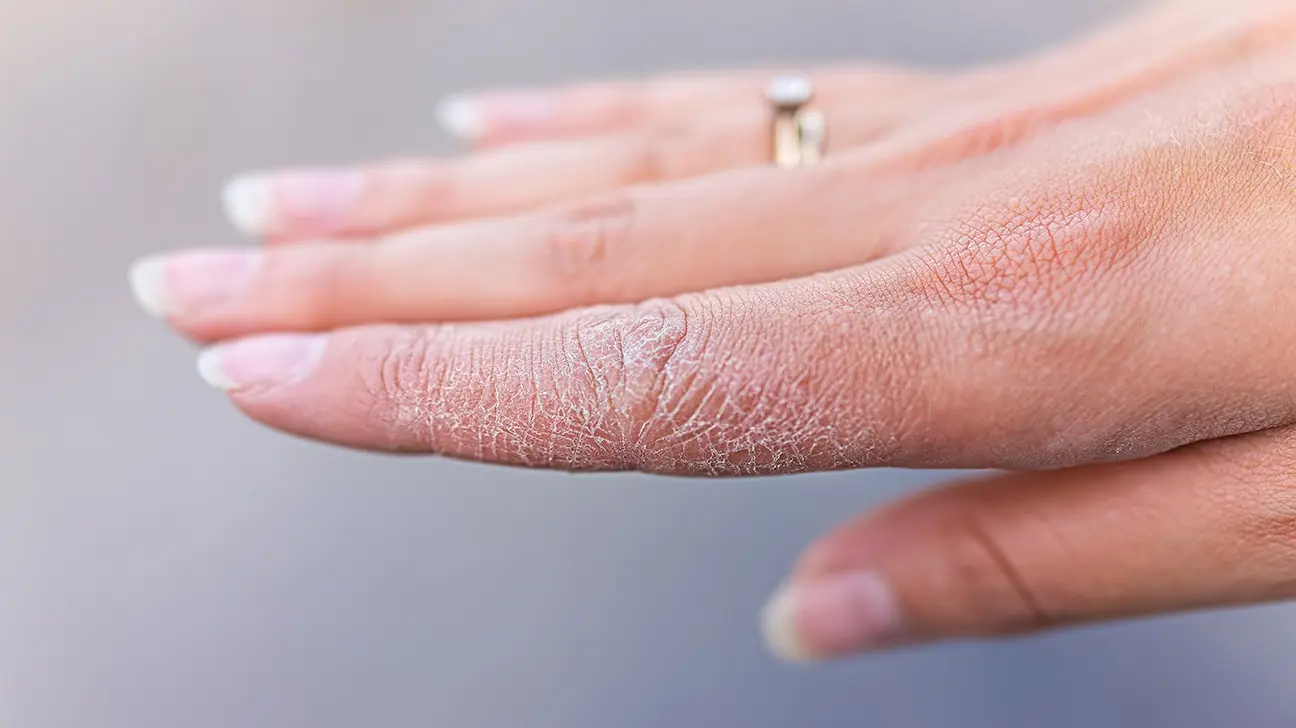 Cracked skin on the fingers &#8211; causes, prevention and treatment