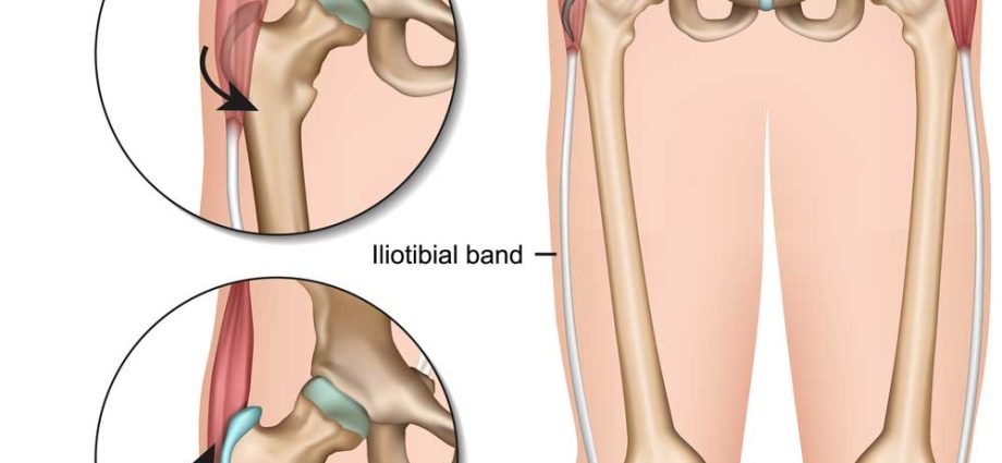 Crackling hip (jumping hip)