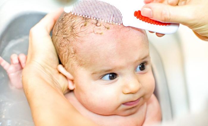 Cradle cap pada bayi – punca, rawatan. Bagaimana untuk menghilangkan topi buaian? [KAMI TERANGKAN]