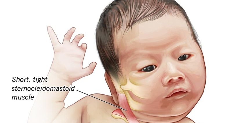 Cramp-like torticollis