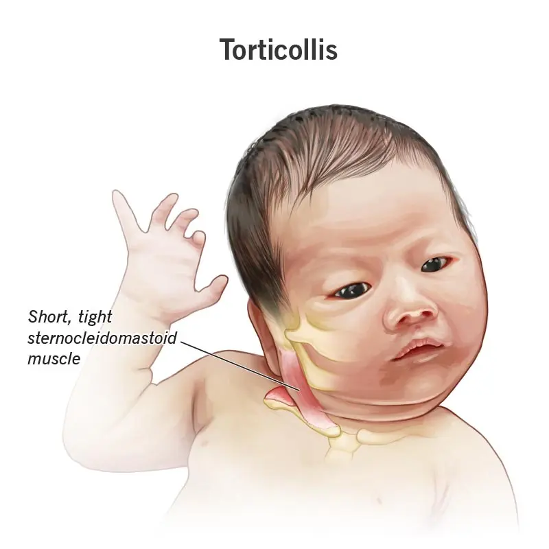 Cramp-like torticollis