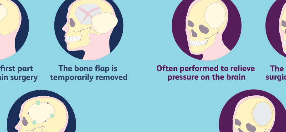 Craniotomy &#8211; what is it, indications, rehabilitation, complications