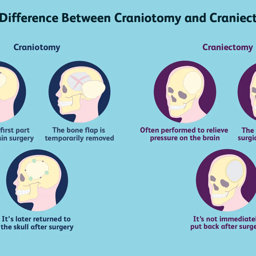 Craniotomy &#8211; what is it, indications, rehabilitation, complications