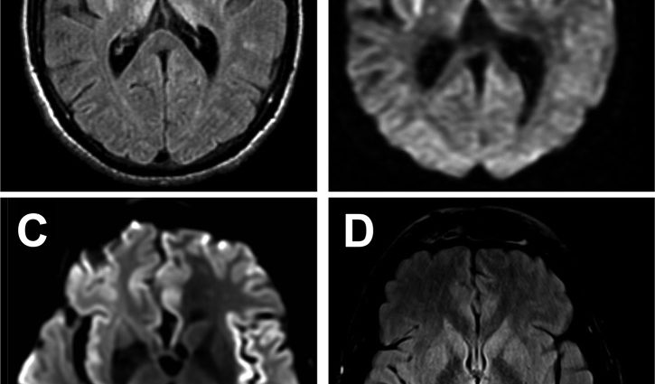 Creutzfeldt-Jakob disease (spongiform degeneration of the brain)