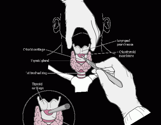 Cricothyrotomy &#8211; indications, contraindications, possible complications. What is the procedure and how to perform it?