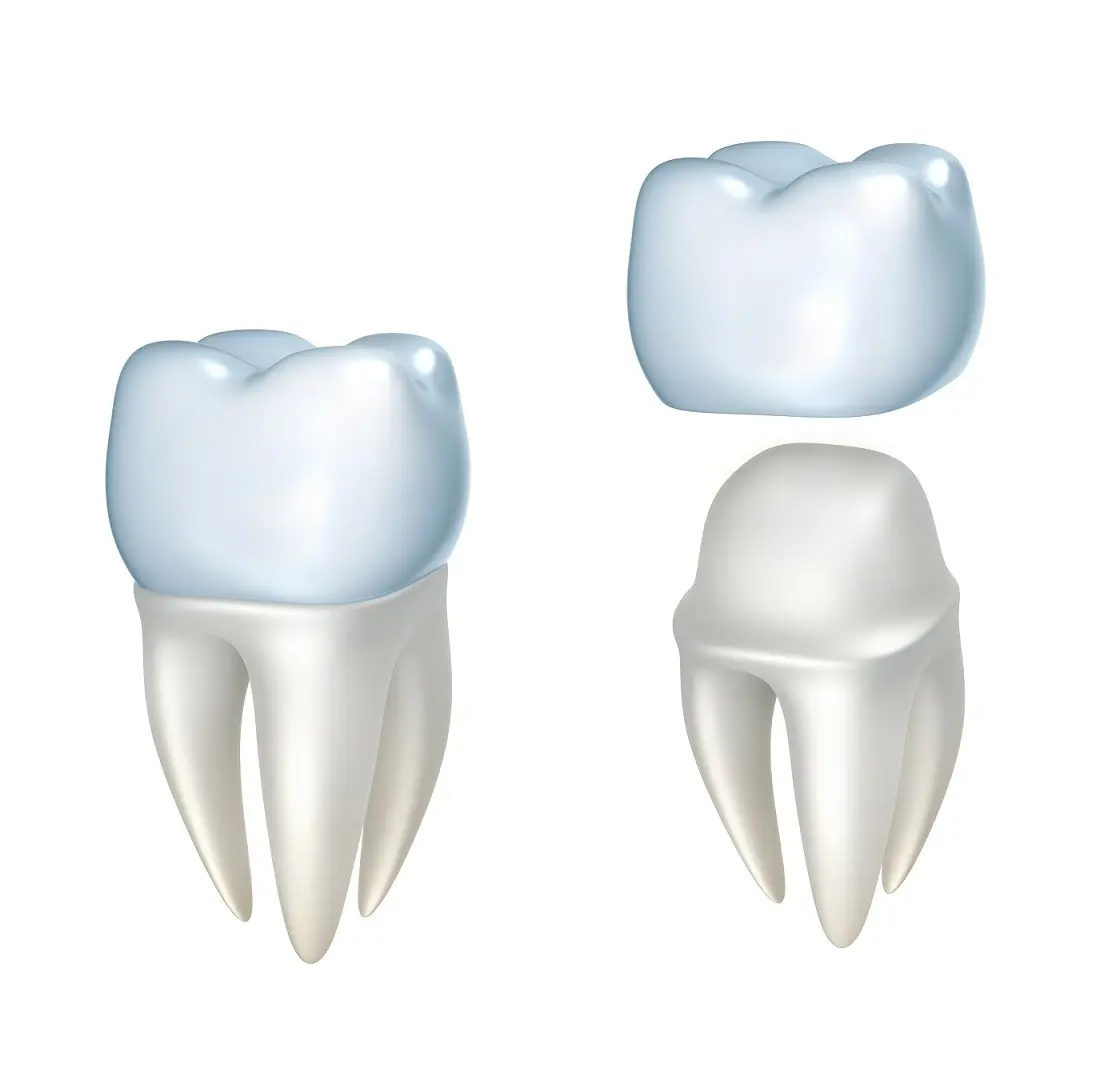 Crown &#8211; veneer &#8211; bridge: similarities and differences