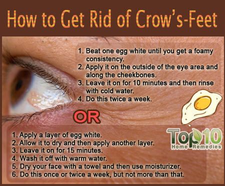 Crow&#8217;s feet &#8211; wrinkle treatments, home remedies