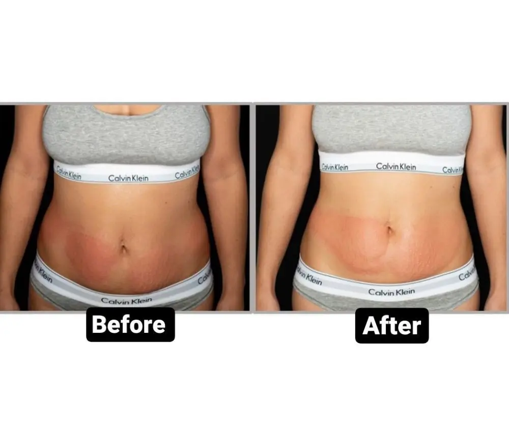 Cryolipolysis for slimming &#8211; the course, contraindications, complications, advantages and disadvantages