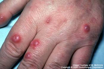 Cryptococcosis