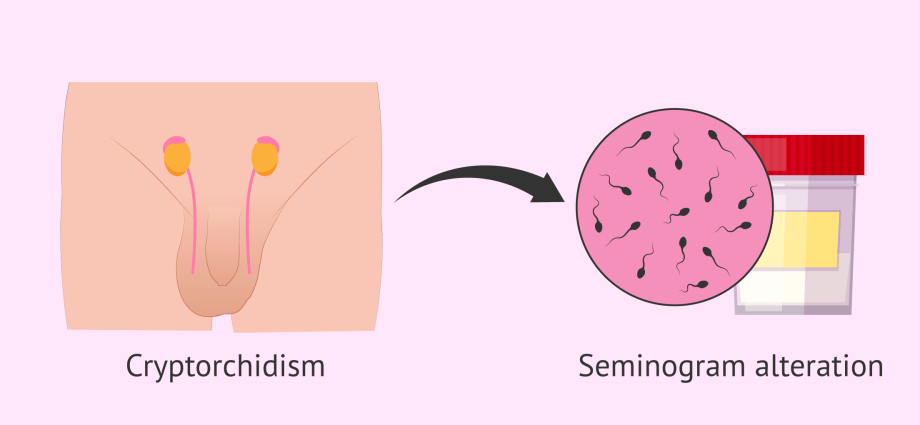 Cryptorchidism and the problem of fertility.