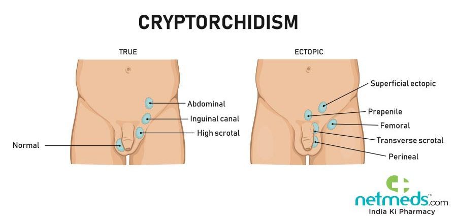 Cryptorchidism &#8211; types, causes, diagnosis, treatment