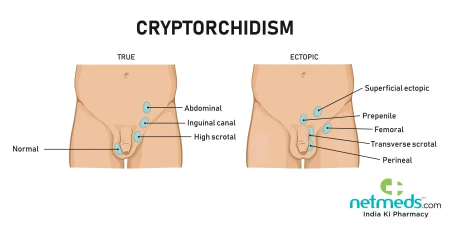 Cryptorchidism &#8211; types, causes, diagnosis, treatment