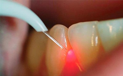 Curettage &#8211; a treatment for gingivitis. What is it about?