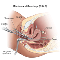 Curettage &#8211; the course of the procedure, indications, possible complications. What is curettage?