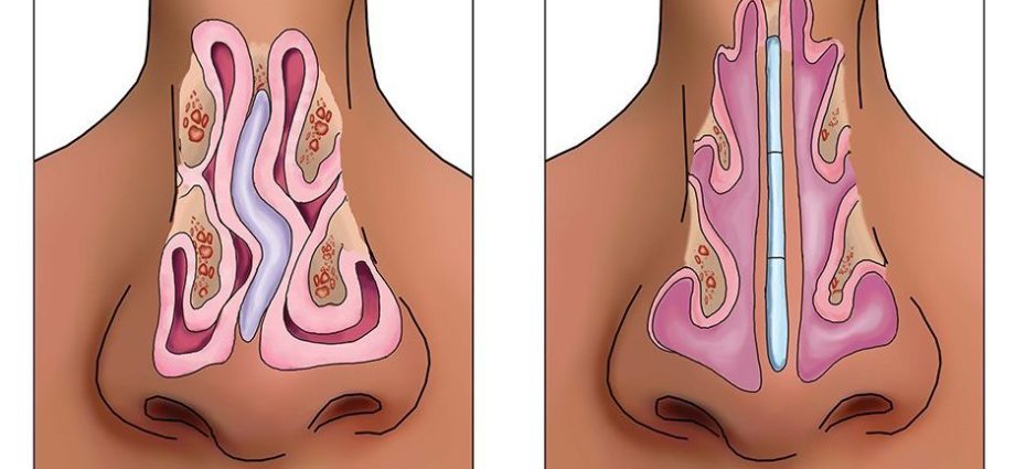 Curve of the nasal septum &#8211; causes, symptoms, treatment, surgery